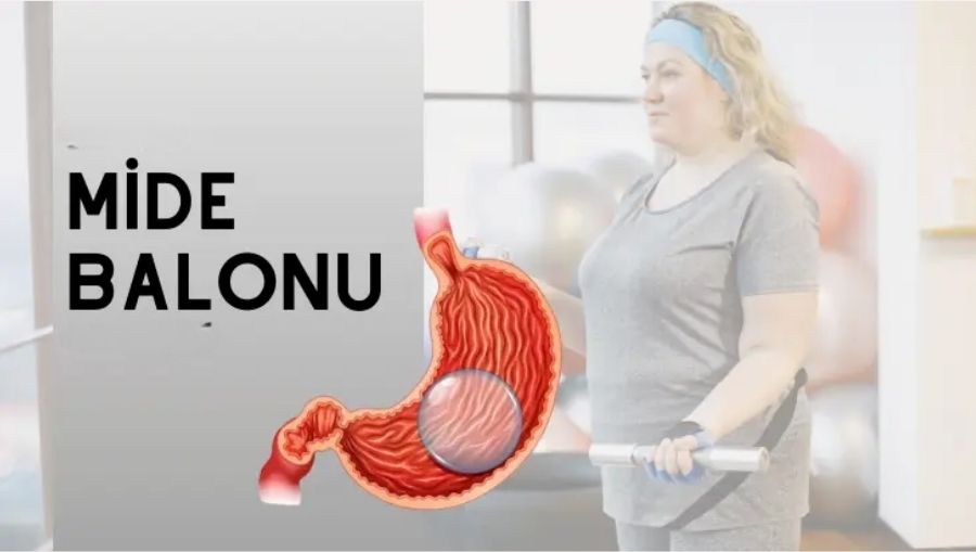 Allurion Mide Balonu